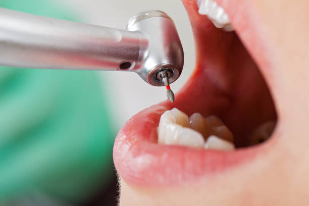 Best Emergency Root Canal Treatment in Richgrove, CA